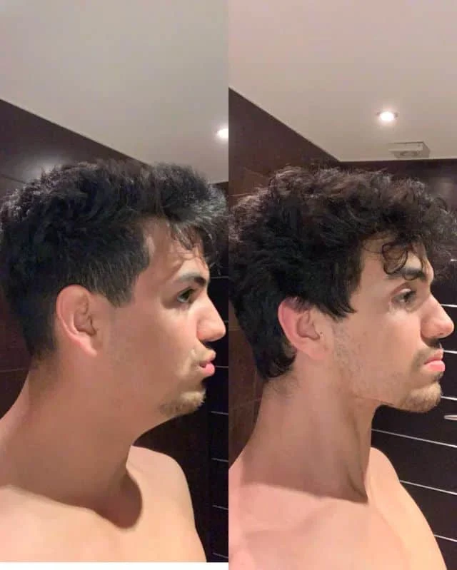 MEWING tackle double chin