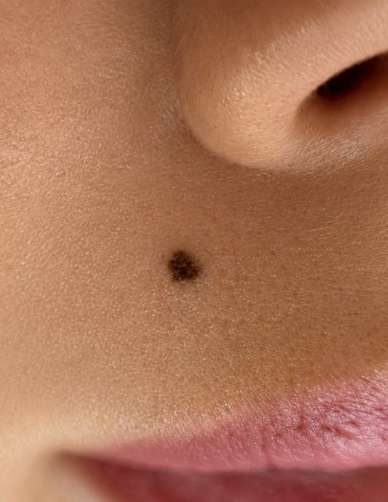 what to wear mole check